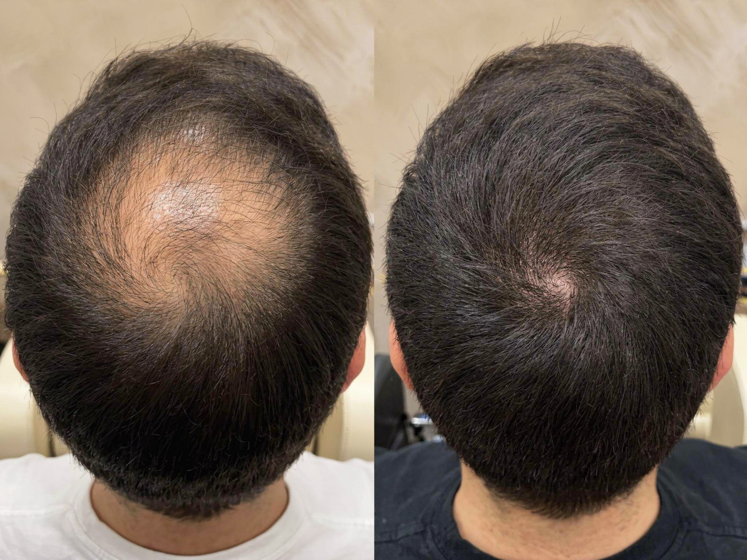Hair restoration patient